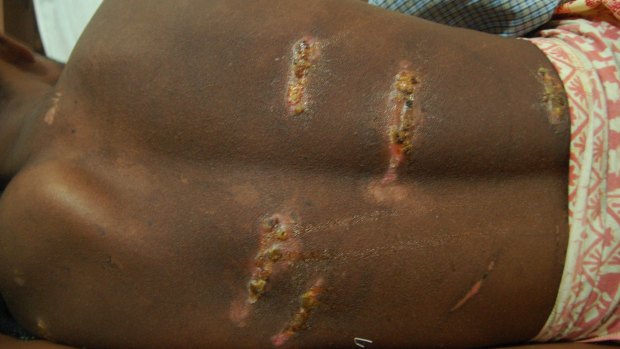 A Rohingya refugee shows the wounds he says he received during a beating in Thailand.