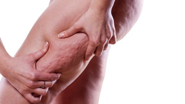 What is Cellulite? The Science Behind Cellulite