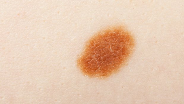 A guide to when you should get the lumps and bumps on your body checked out.