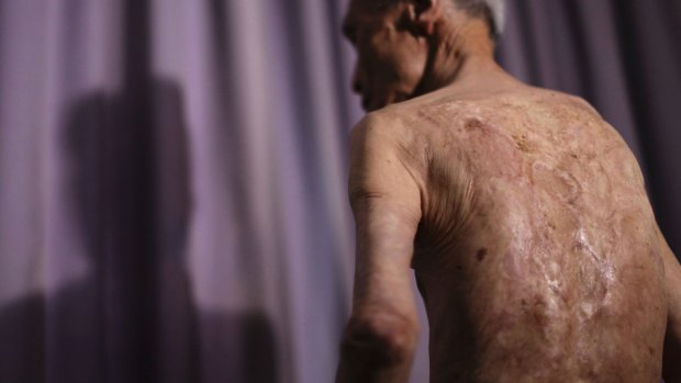 Sumiteru Taniguchi, a survivor of the 1945 atomic bombing of Nagasaki, shows the scars on his back from the burns.