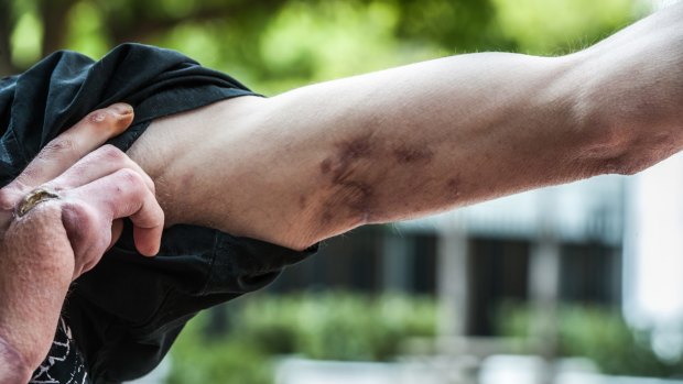 Daniel Meyers' scarred arm.