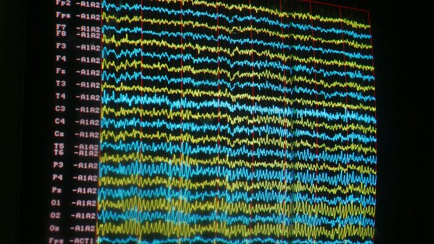 An EEG measures electrical activity of the brain. "Scalp electrodes translate neurological activity into waves, cerebral squiggles that show how well our brain machines are working," explains neurologist Sandra Block.
