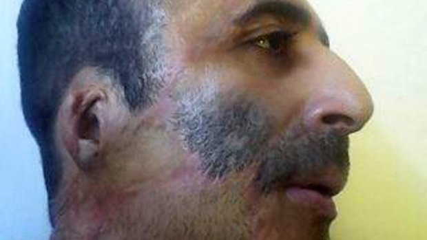 Burns victim Iranian man Majid Karami Kamasaei.