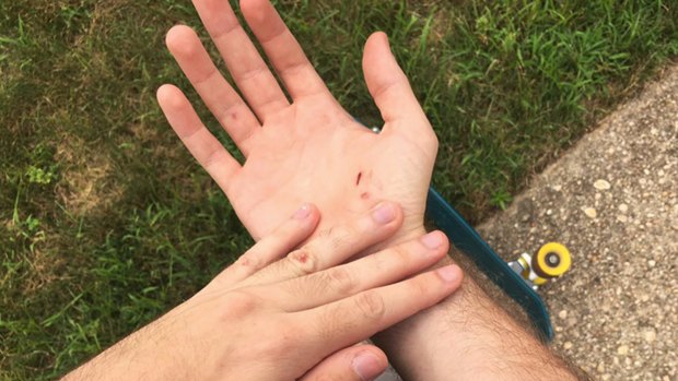Mike Schultz from Long Island shows injuries he received when he crashed his skateboard while playing Pokemon Go.