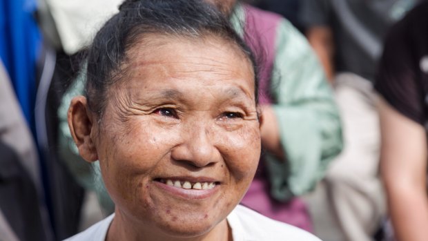 Chandra Maya Rai after her surgery in Kalimpong.