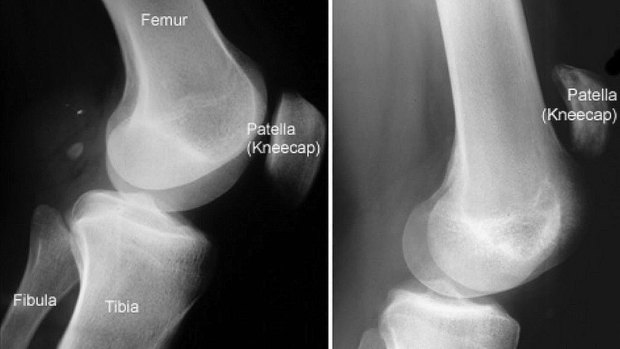 Left: An X-ray shows the normal location of a kneecap. Right: The kneecap has moved up the leg due to a patella tendon rupture. (These are not Kurtley Beale's X-rays).