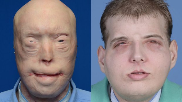 Patrick Hardison before and after his facial transplant surgery in New York. 