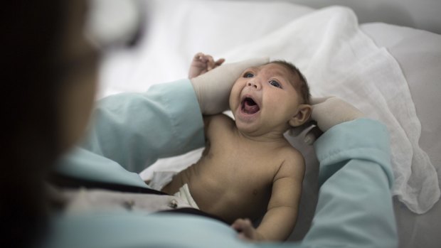 A baby with microcephaly in Brazil in February.