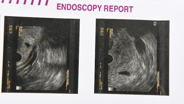 An image from Carmel Pickup's endoscopic ultrasound showing a non-cancerous cyst on her pancreas.