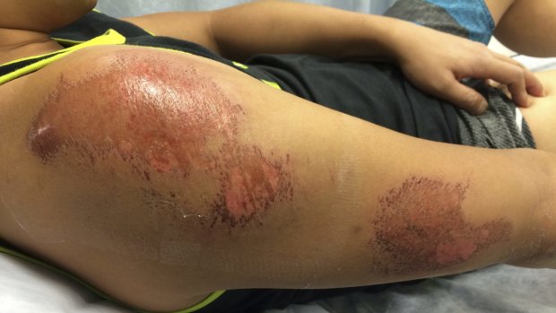 A close-up of Ray Kan's grazed shoulder and arm.