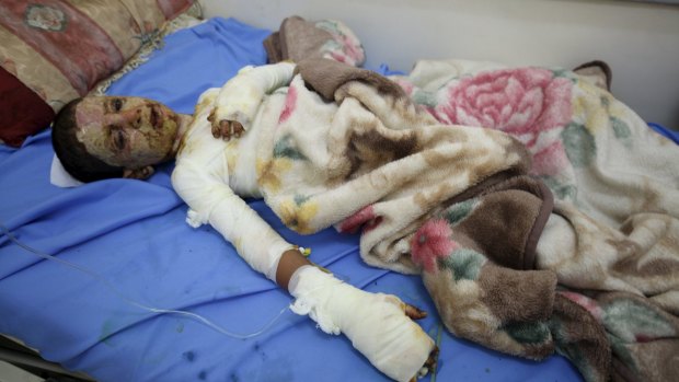 A boy injured in a recent Saudi-led air strike lies on a hospital bed in Yemen's capital Sanaa on Saturday.