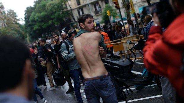A man shows a bruise on his back allegedly caused by Spanish riot police after clashes near a school assigned to be a polling station.