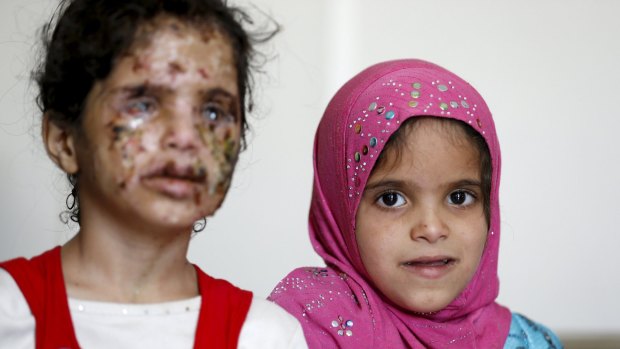 Nine-year-old Walaa Hussein al-Hutroum, left, sits with her twin sister Huda at a hospital where she is being treated for injuries said to have been sustained from an air strike in Sanaa, Yemen.