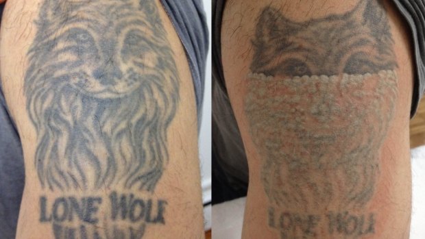 Boom in tattoo removal businesses