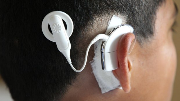 A Cochlear ear device.