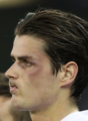 Shiner: Tom Boyd of the Bulldogs looks on with a black eye.