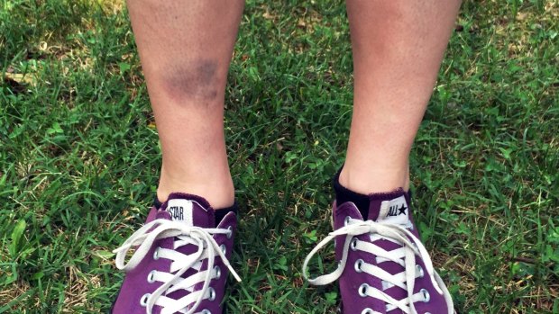 The bruised shin of Lindsay Plunkett from North Carolina, who tripped over a block while playing Pokemon Go.