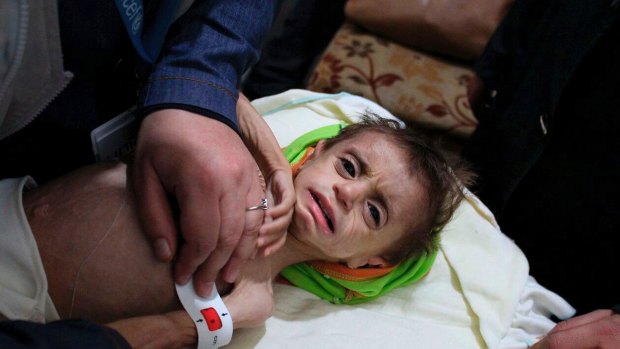A severely malnourished child is treated at the al-Kahef hospital in Kafr Batna, Eastern Ghouta in October.