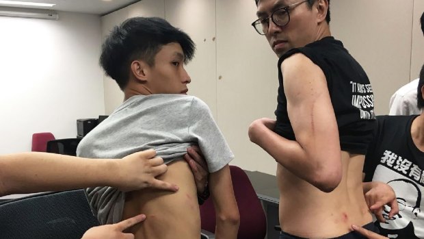A student (left) and League of Social Democrats chairman Avery Ng reveal their injuries.