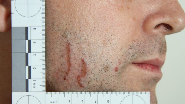 Police photographs of marks on Gerard Baden-Clay's face and body.