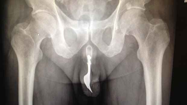 Doctors at Canberra Hospital were once tasked with removing a fork from inside an elderly man's penis.