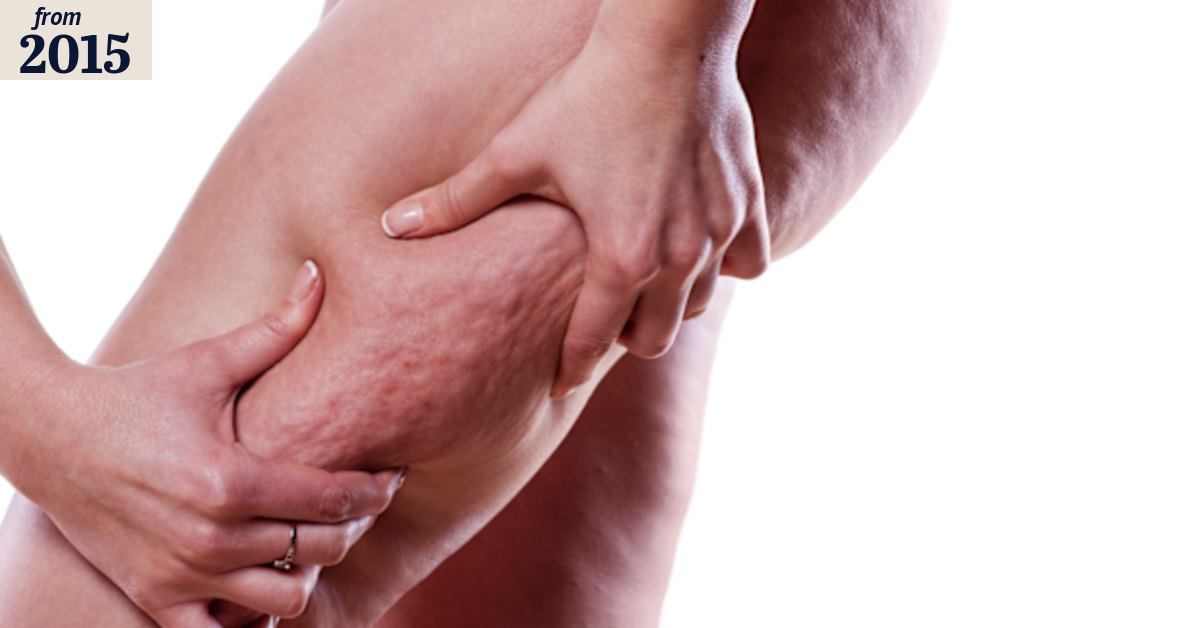 Cellulite: The truth about the white woman's curse