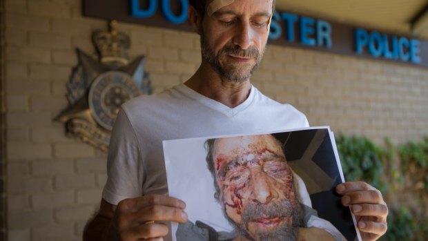 Paul Cenci shows a photo of himself in hospital with the horrific injuries he suffered in a savage attack last month.