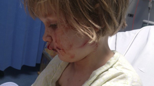 Phoebe Hettinger was bitten on the face – leaving her scarred.