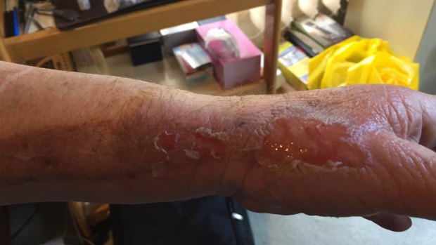 Sam Herbath's skin after he fell onto the Harold Holt Memorial Swimming Centre's sauna. 