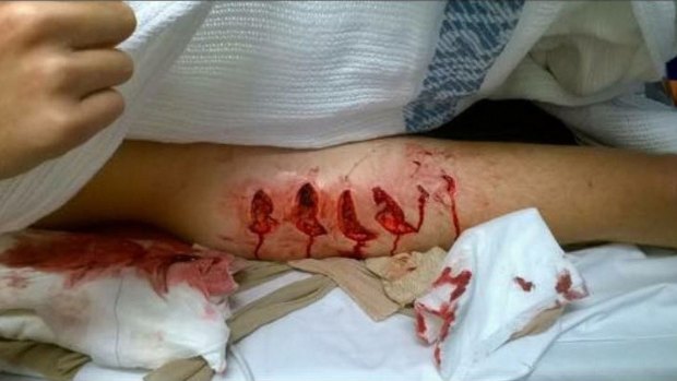 The horrific wounds on Cooper Allen's leg after being bitten by a shark at Lighthouse Beach in Ballina on Monday. 