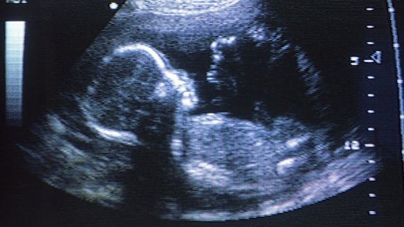 The number of Australian children who die from HDN has fallen more than a hundred-fold since anti-D preventative treatment was introduced.