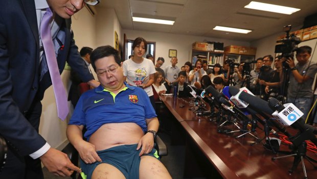 Howard Lam displays his wounds on his thigh after stapled with crosses during a press conference in Hong Kong.