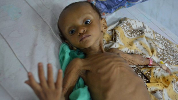 A boy who suffers from malnutrition lies on a bed at a hospital in Hodeidah, Yemen. Even before the war, Hodeidah was one of the poorest cities in Yemen, the Arab world's most impoverished nation. 