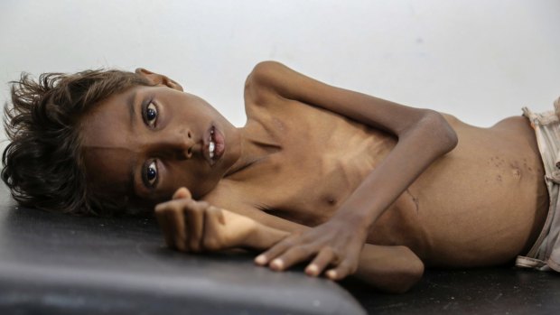 Five-year-old Mohannad Ali lies on a hospital bed in Abs, Yemen, in December. His two-year-old cousin died of hunger.