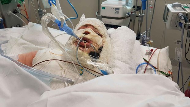 A 28-year-old woman who suffered severe burns to her face and body when a burner exploded in her backyard in Western Australia.