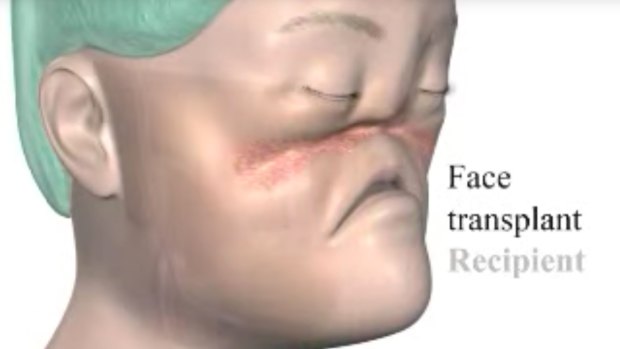 A still from a Cleveland Clinic video explaining the full-face transplant.