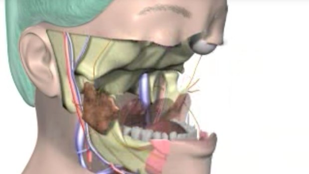 A second still from a Cleveland Clinic video explaining the full-face transplant.