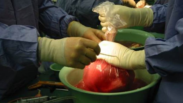 Doctors prepare a kidney for transplant.