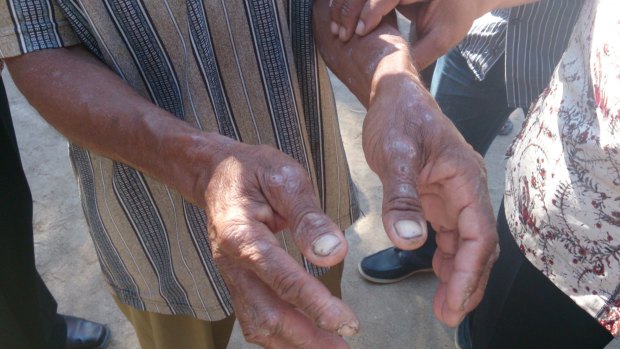 The hands of a man in Indonesia's East Nusa Tenggara province in August 2013. People in the region complain of itchy skin conditions, possibly connected to the spill.