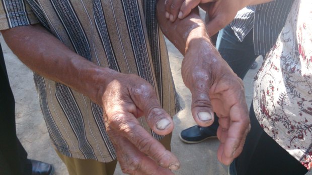 The hands of a man in Indonesia's East Nusa Tenggara province in August 2013. People in the region complain of itchy skin conditions, possibly connected to the spill.