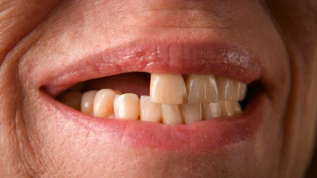 Her original dental implants had cracked and needed to be replaced.