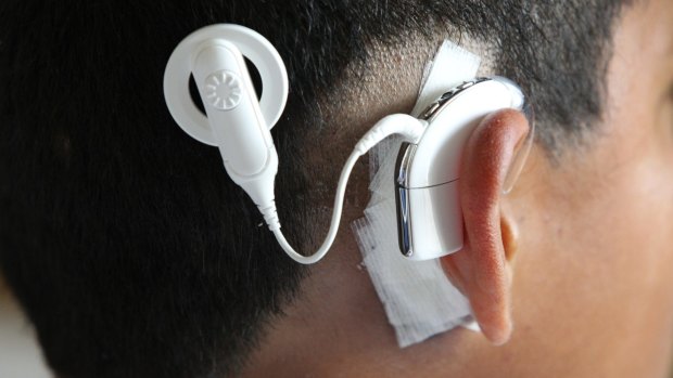 A Cochlear ear device.