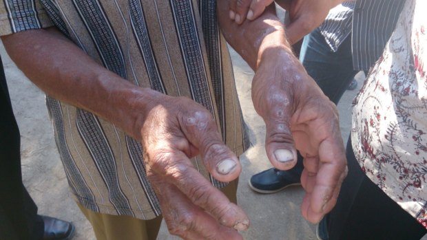 The hands of a man in Indonesia's East Nusa Tenggara province in August 2013. People in the region complain of itchy skin conditions, possibly connected to the spill.