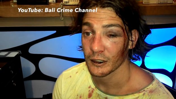 The Perth man shortly after he claims he was bashed by security guards in Bali. 
