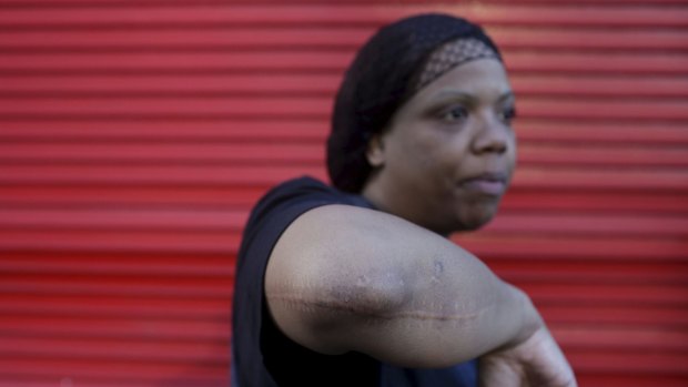 Chicago resident Gloria Johnson shows the scar of where she was shot in her arm in 2007.