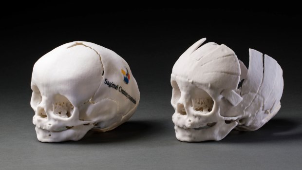 Surgeon Professor David David chose models of skulls taken from patient CT scans.