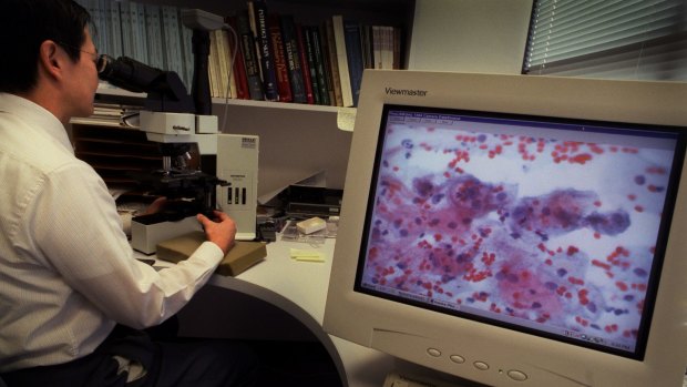 A pathologist analyses an abnormal Pap smear.