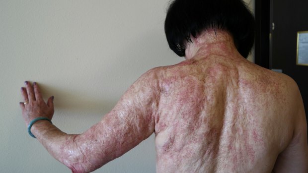 Kim Phuc shows the  scars  for which she is receiving laser treatments in Miami.