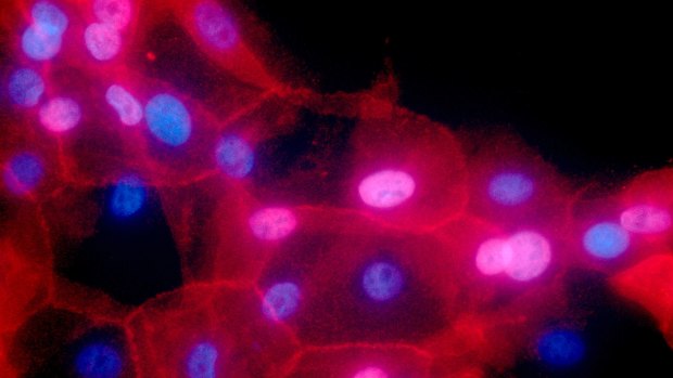 Fluorescence-coloured microscope image from the National Institutes of Health shows a culture of human breast cancer cells. Cancer funding is to receive a boost.