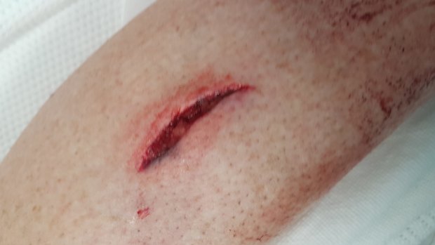 One of the bites Banks woman Kerry Evans sustained when she was attacked by a wombat.